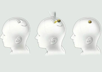 Neuralink Ainda Não Divulgou Como Será Feito Os Estudos E Quando As Cobaias Humanas Serão Convocadas | Instagram/@Neuralink__