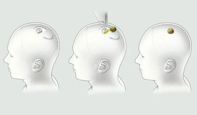 Neuralink Ainda Não Divulgou Como Será Feito Os Estudos E Quando As Cobaias Humanas Serão Convocadas | Instagram/@Neuralink__