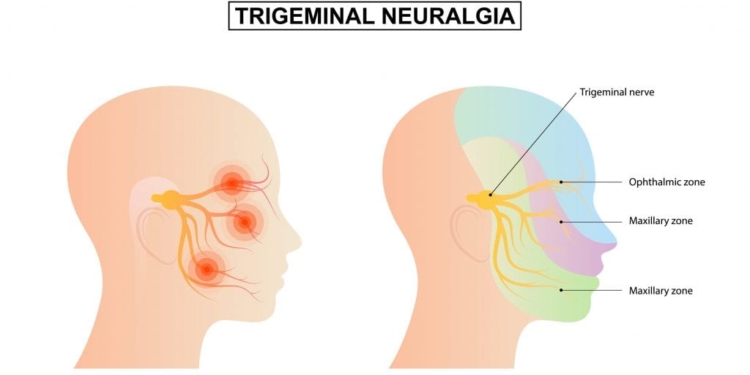 Entenda O Que E Neuralgia Do Trigemeo Que Faz Brasileira Gazeta Mercantil