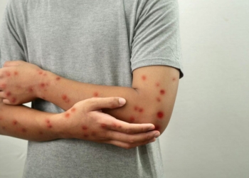 Mpox No Brasil Chega A 88 Casos Em 2026 Após Novo Registro No Espírito Santo - Gazeta Mercantil