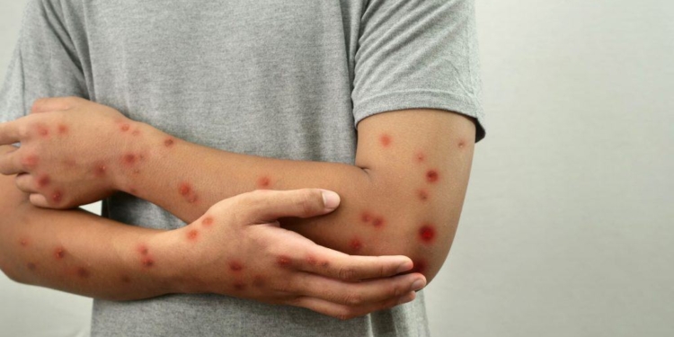 Mpox No Brasil Chega A 88 Casos Em 2026 Após Novo Registro No Espírito Santo - Gazeta Mercantil