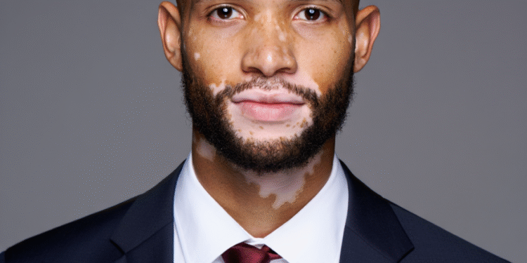 Vitiligo Dá Direito Ao Inss? Saiba Quando Tem Benefício Modelo Com Vitiligo Cassio (Major Model) Foto Adriano Paiva - Gazeta Mercantil