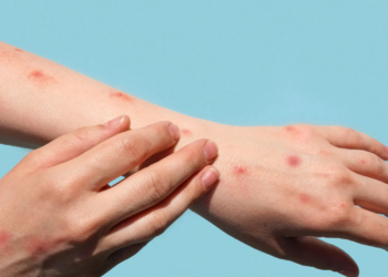 Casos de mpox no Brasil chegam a 140 em 2026, diz Ministério da Saúde 8 GAZETA MERCANTIL Casos De Mpox No Brasil Chegam A 140 Em 2026, Diz Ministério Da Saúde - Gazeta Mercantil