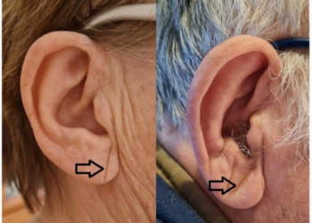Orelha E Infarto: O Que Um Sinal Discreto Pode Revelar Sobre O Coração